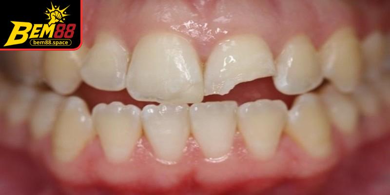 Giấc mơ về răng vỡ hoặc gãy răng nhắc nhở những rủi ro hoặc trở ngại bất ngờ